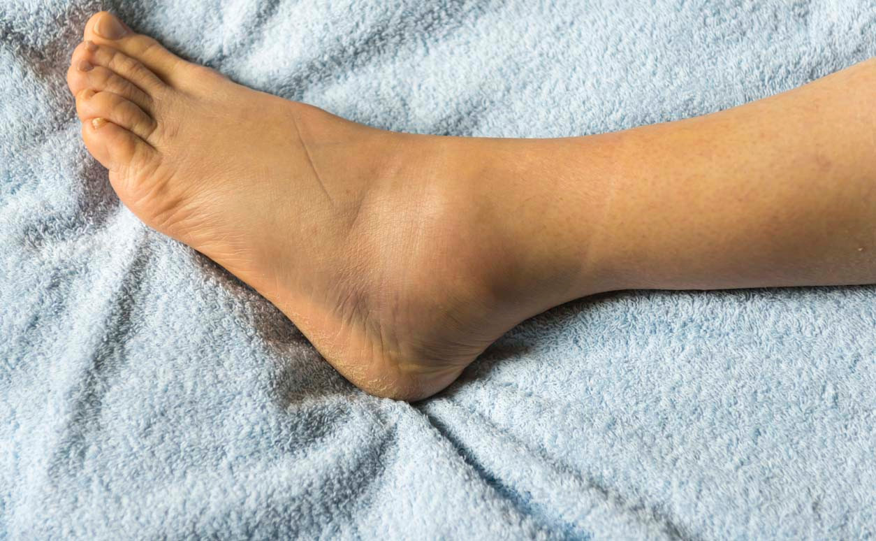Terapi Kaki Bengkak Alami di Jogja: Jalan Sunyi Menuju Pemulihan Tanpa Efek Samping